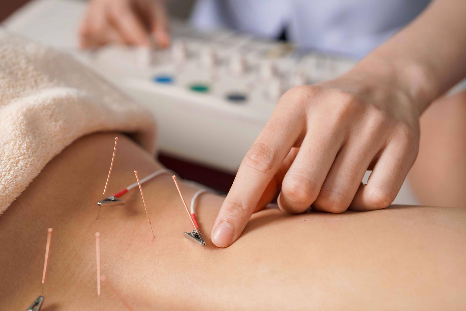 electrical acupuncture 