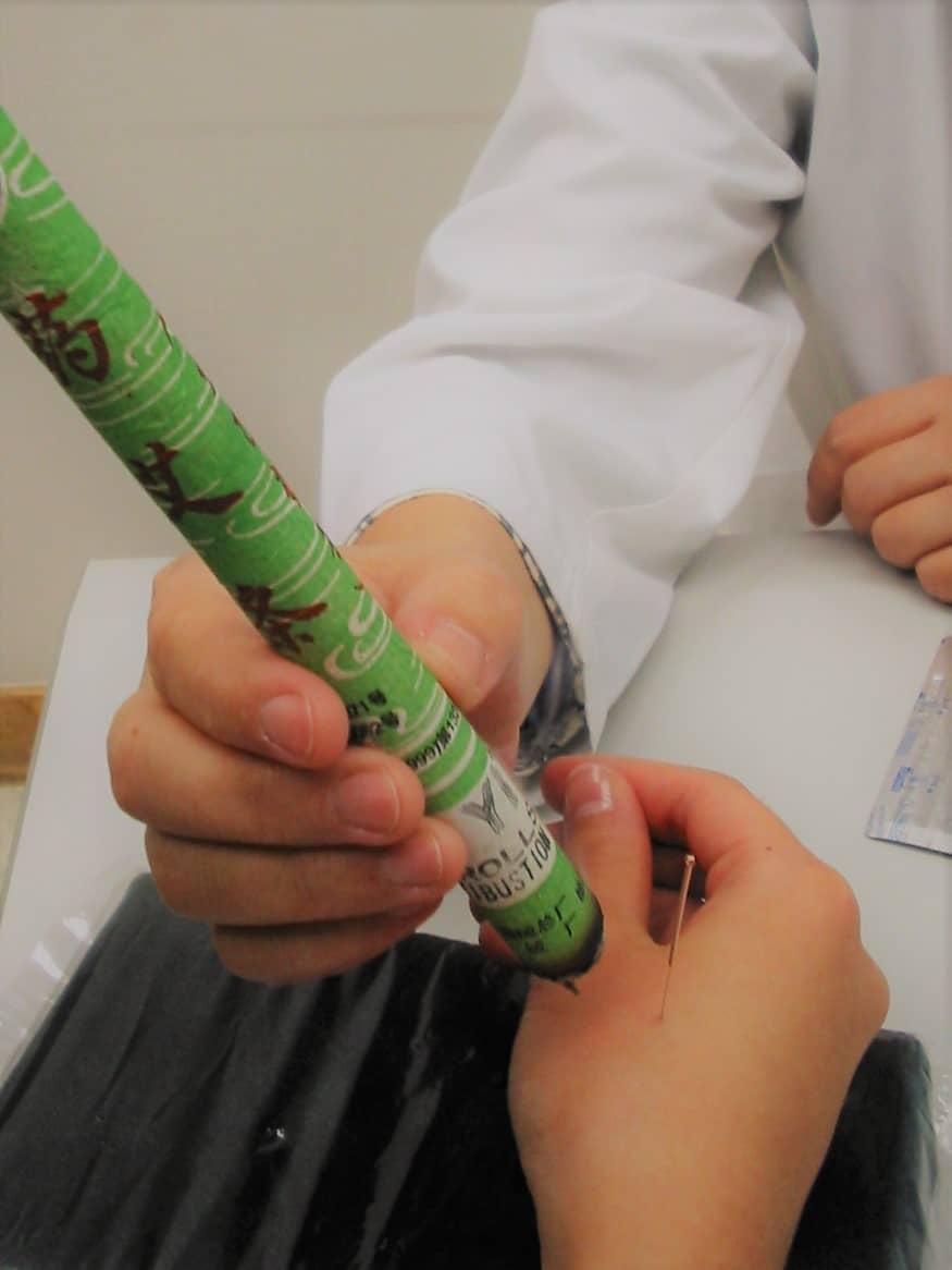 moxibustion