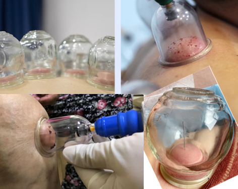 bloodletting plus cupping bloodletting plus cupping