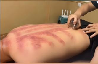 Sliding cupping on the back Sliding cupping on the back