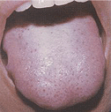 A purplish tongue